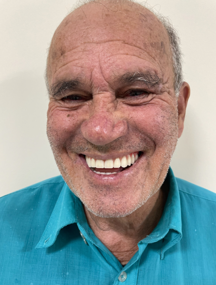 Overdenture
